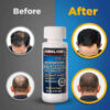Minoxidil férfi - 6 darab