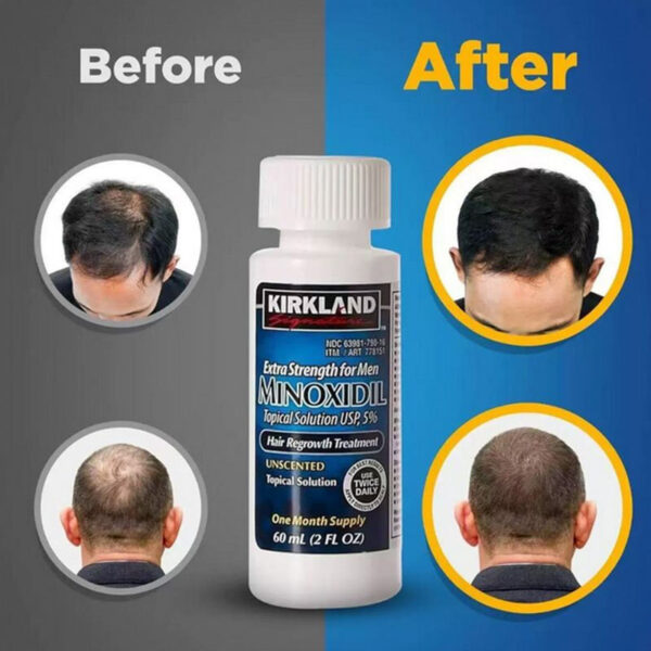 Minoxidil férfi - 6 darab