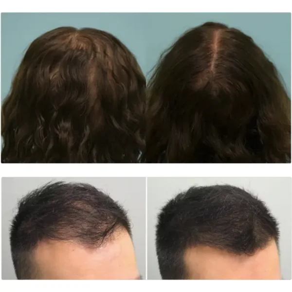 Minoxidil férfi - 6 darab