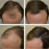 Minoxidil férfi - 6 darab
