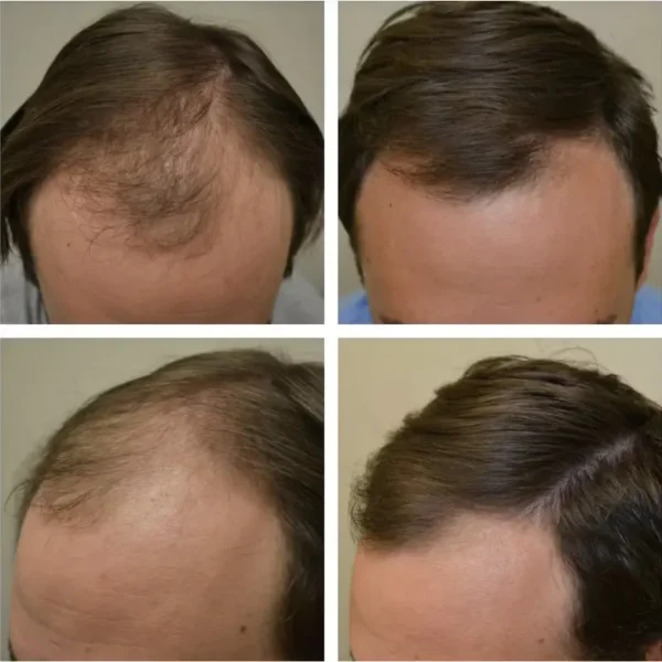 Minoxidil férfi - 6 darab